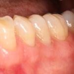 After image of a teeth and gums repaired