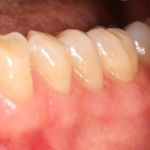 After image of a teeth and gums repaired