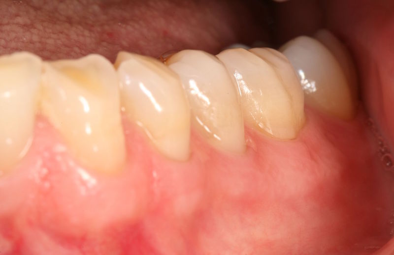 After image of a teeth and gums repaired