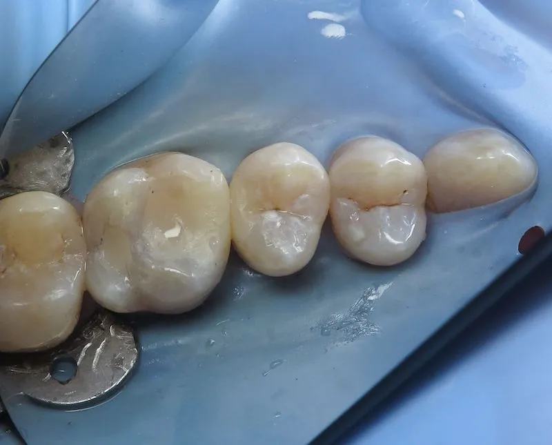 Tooth colored restoration