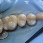 Tooth colored restoration