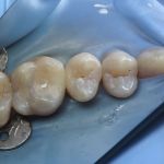 Tooth colored restoration