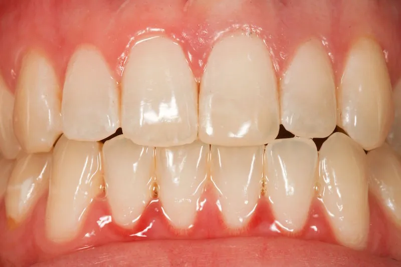 After image of a mouth with a the chipped tooth fixed.