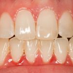 After image of a mouth with a the chipped tooth fixed.