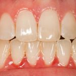 After image of a mouth with a the chipped tooth fixed.