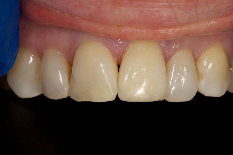 After image of a mouth with a the chipped tooth fixed.