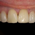 After image of a mouth with a the chipped tooth fixed.
