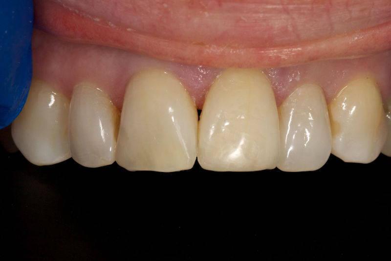 After image of a mouth with a the chipped tooth fixed.