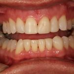 After image of a mouth with straight teeth