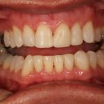 After image of a mouth with straight teeth