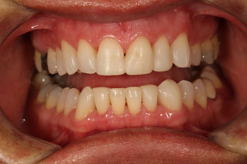After image of a mouth with straight teeth