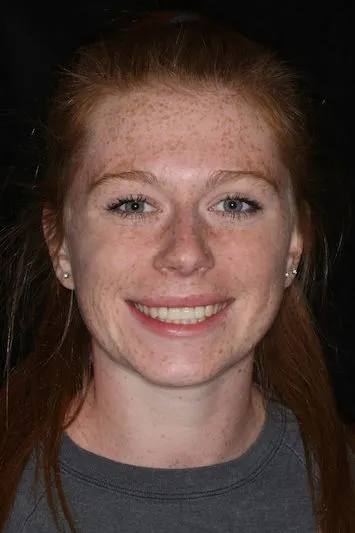 Young woman with new front teeth
