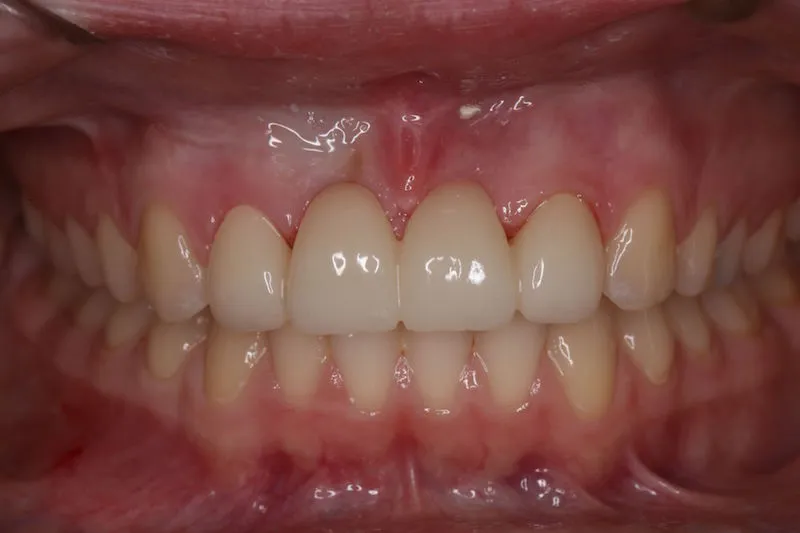 After image of a mouth with front teeth replaced