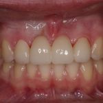 After image of a mouth with front teeth replaced