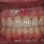 After image of a mouth with front teeth replaced