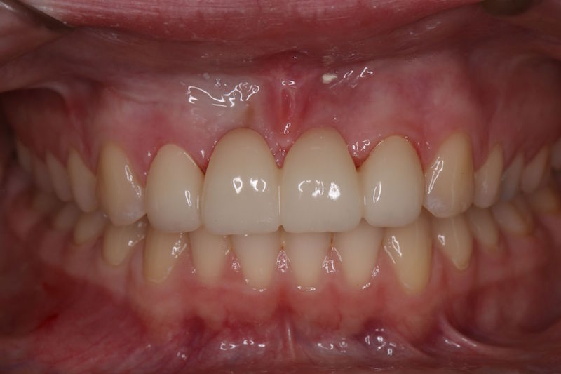 After image of a mouth with front teeth replaced