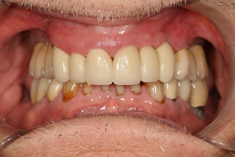 After image of a mouth with dental implants