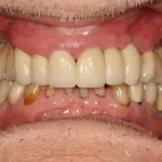 After image of a mouth with dental implants