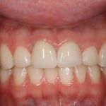 After image of a mouth 