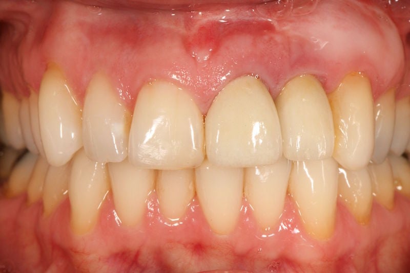 After image of a mouth with a new tooth