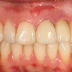 After image of a mouth with a new tooth