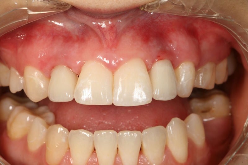 After image of a mouth with the two teeth replaced