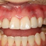 After image of a mouth with the two teeth replaced