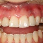 After image of a mouth with the two teeth replaced
