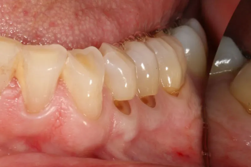 Before image of a teeth with low gums