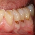 Before image of a teeth with low gums
