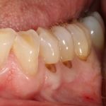 Before image of a teeth with low gums