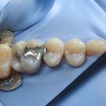 Silver Filling