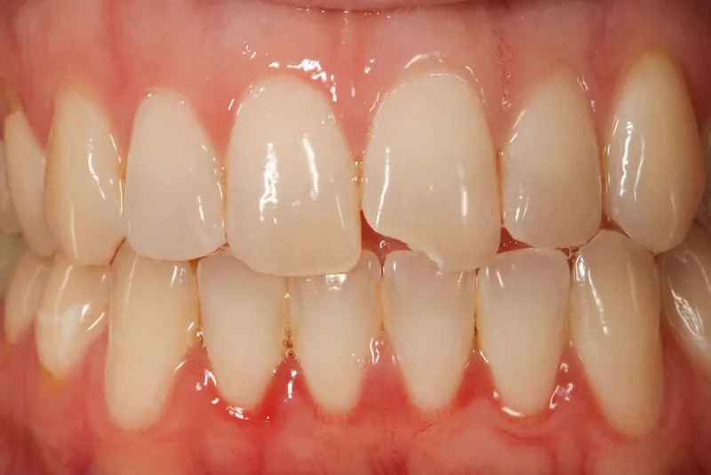 Before image of a mouth with a chipped tooth