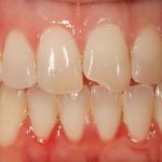 Before image of a mouth with a chipped tooth