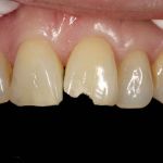 Before image of a mouth with a chipped tooth