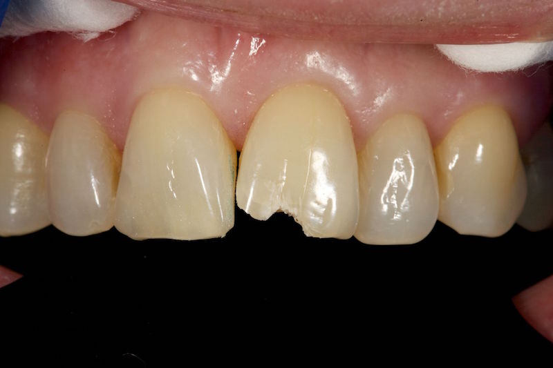 Before image of a mouth with a chipped tooth