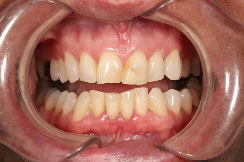 Before image of a mouth with jagged, crooked teeth