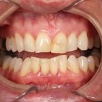 Before image of a mouth with jagged, crooked teeth