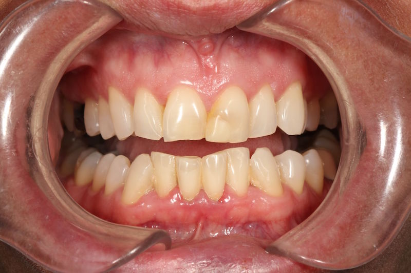 Before image of a mouth with jagged, crooked teeth