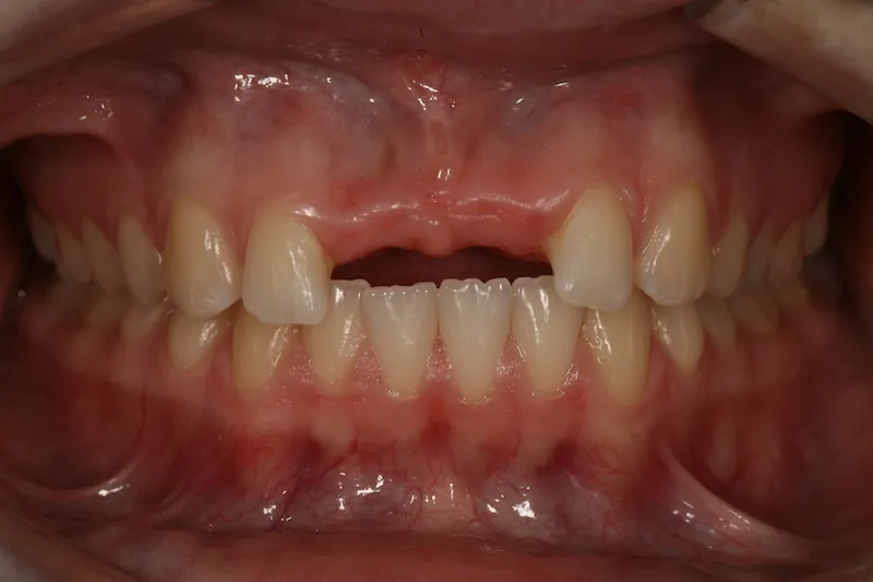 Before image of a mouth missing two front teeth