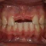 Before image of a mouth missing two front teeth
