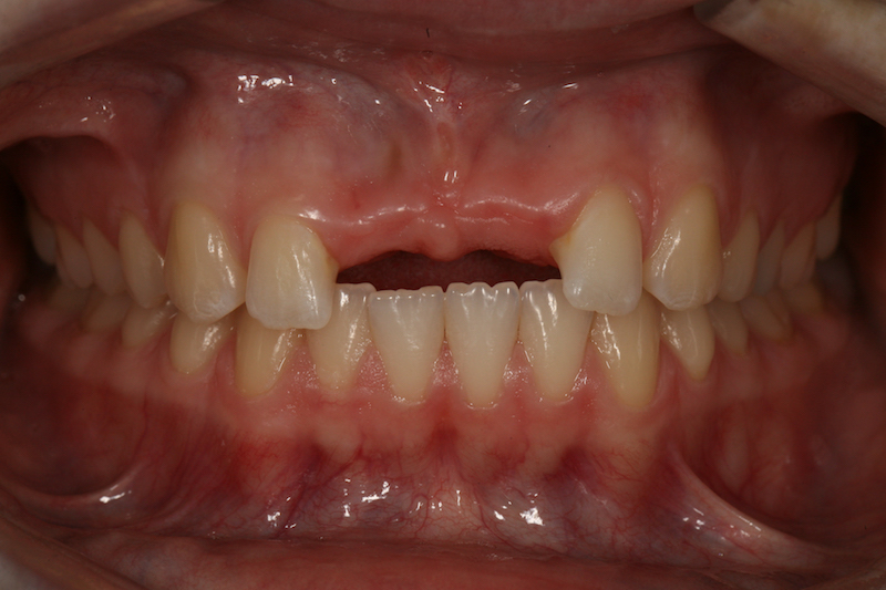 Before image of a mouth missing two front teeth