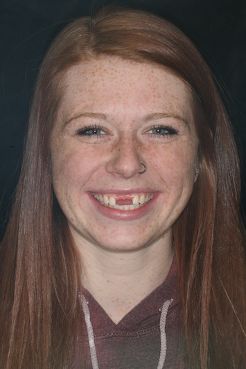 Young woman missing front teeth