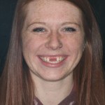 Young woman missing front teeth