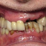 Before image of a mouth with multiple missing teeth and others in bad shape.