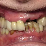 Before image of a mouth with multiple missing teeth and others in bad shape.