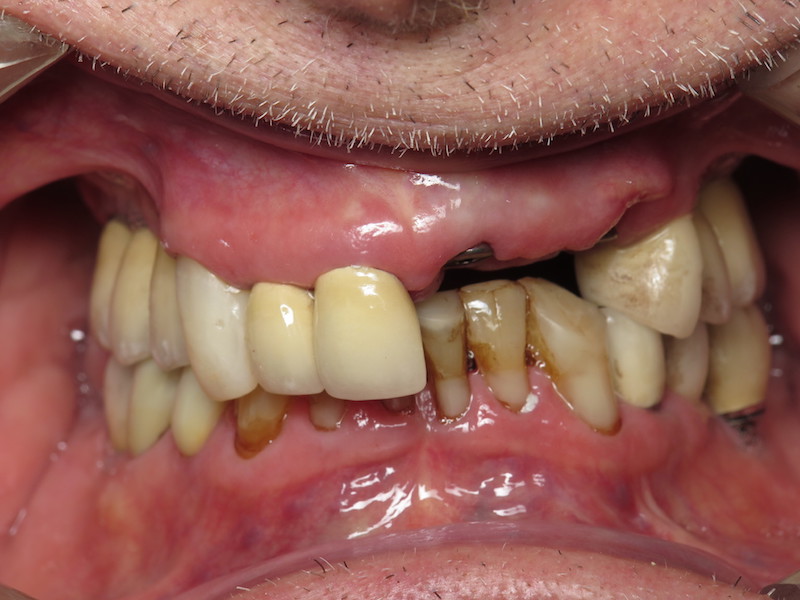 Before image of a mouth with multiple missing teeth and others in bad shape.