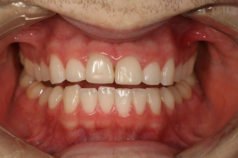 Before image of a mouth