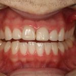 Before image of a mouth 