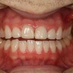 Before image of a mouth 